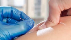 Dry Needling: What Is It and How Does It Work?